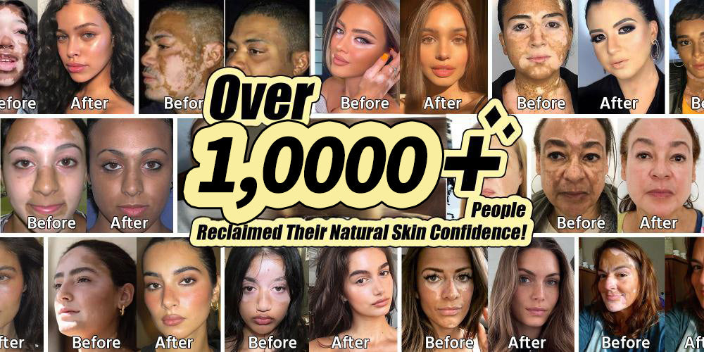 Lovilds® Evenora Vitiligo Herbal Spray